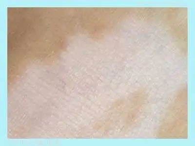 白癜风的预防工作是哪些