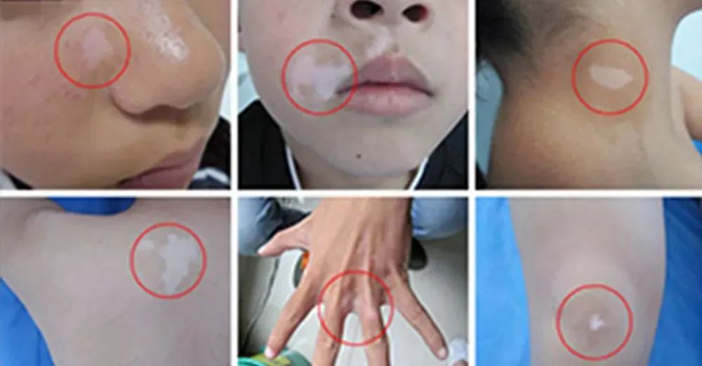 白癜风症状的出现有哪些原因呢？